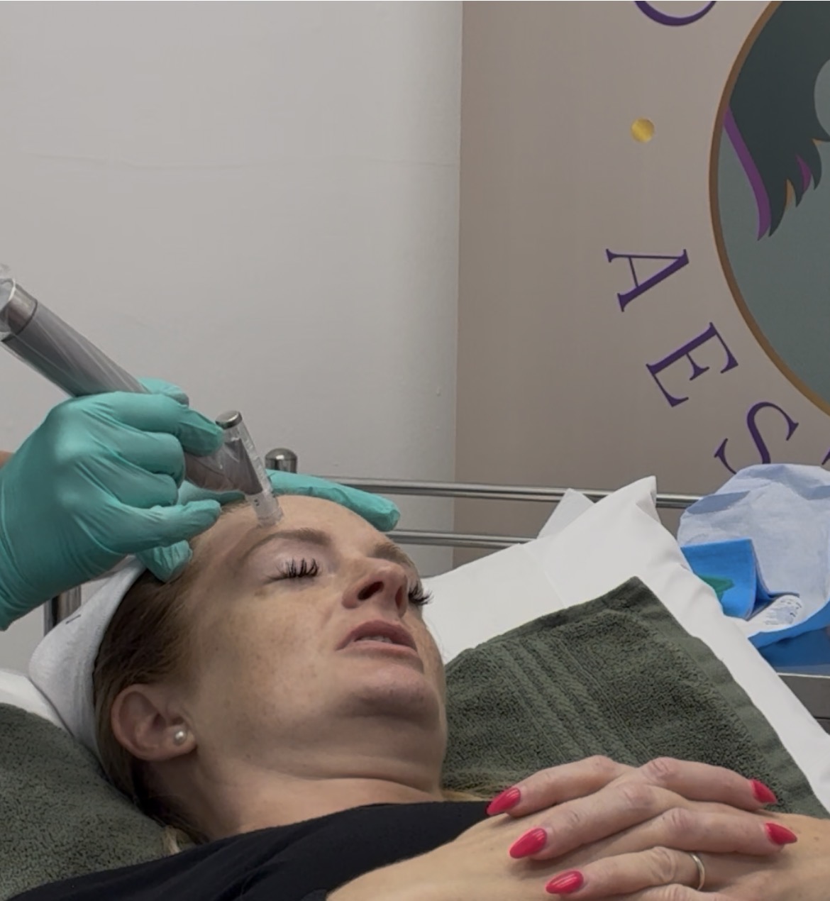 Microneedling Treatment