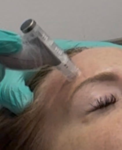 Microneedling treatment in progress
