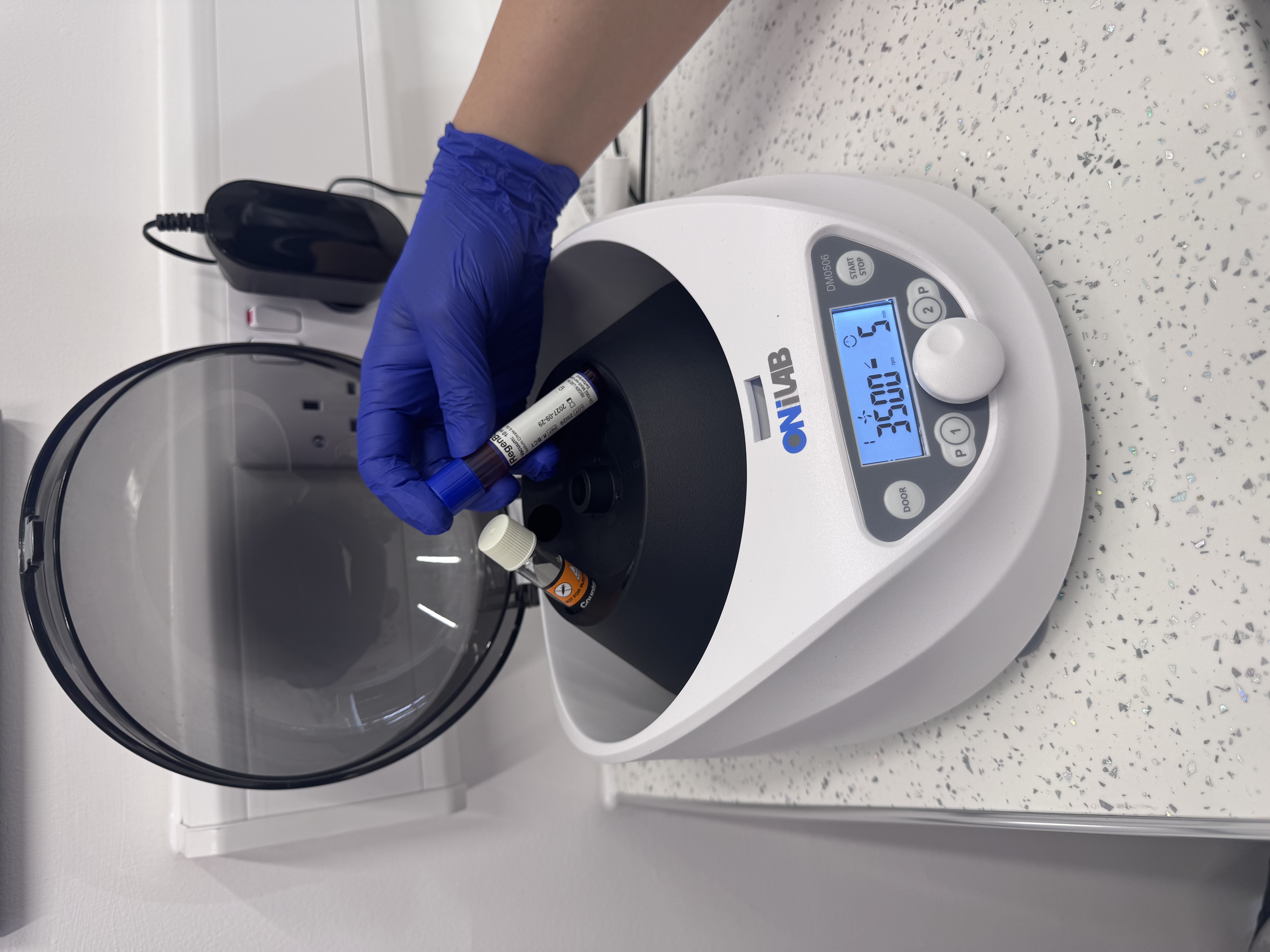 PRP treatment in progress