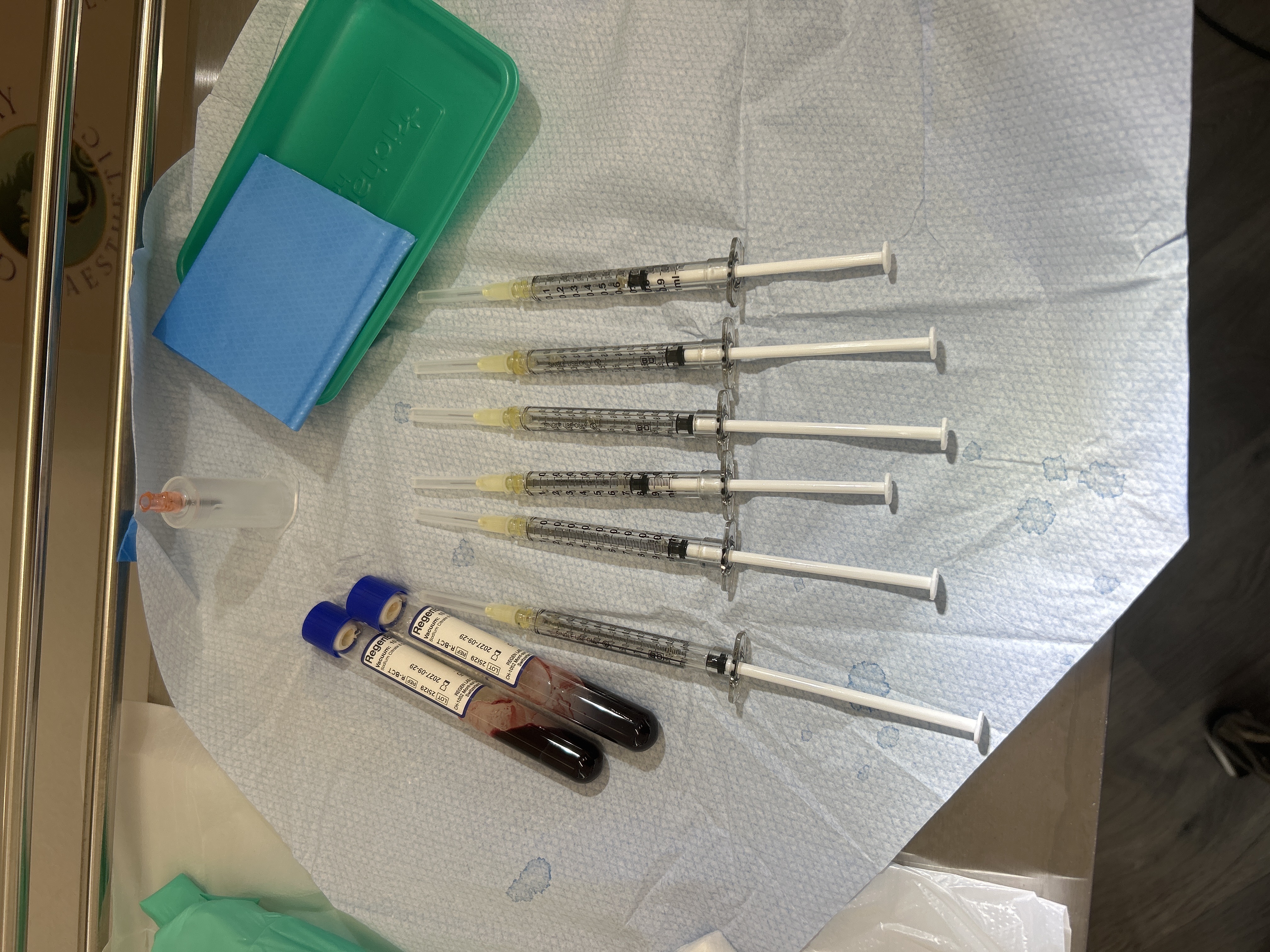 PRP treatment in progress