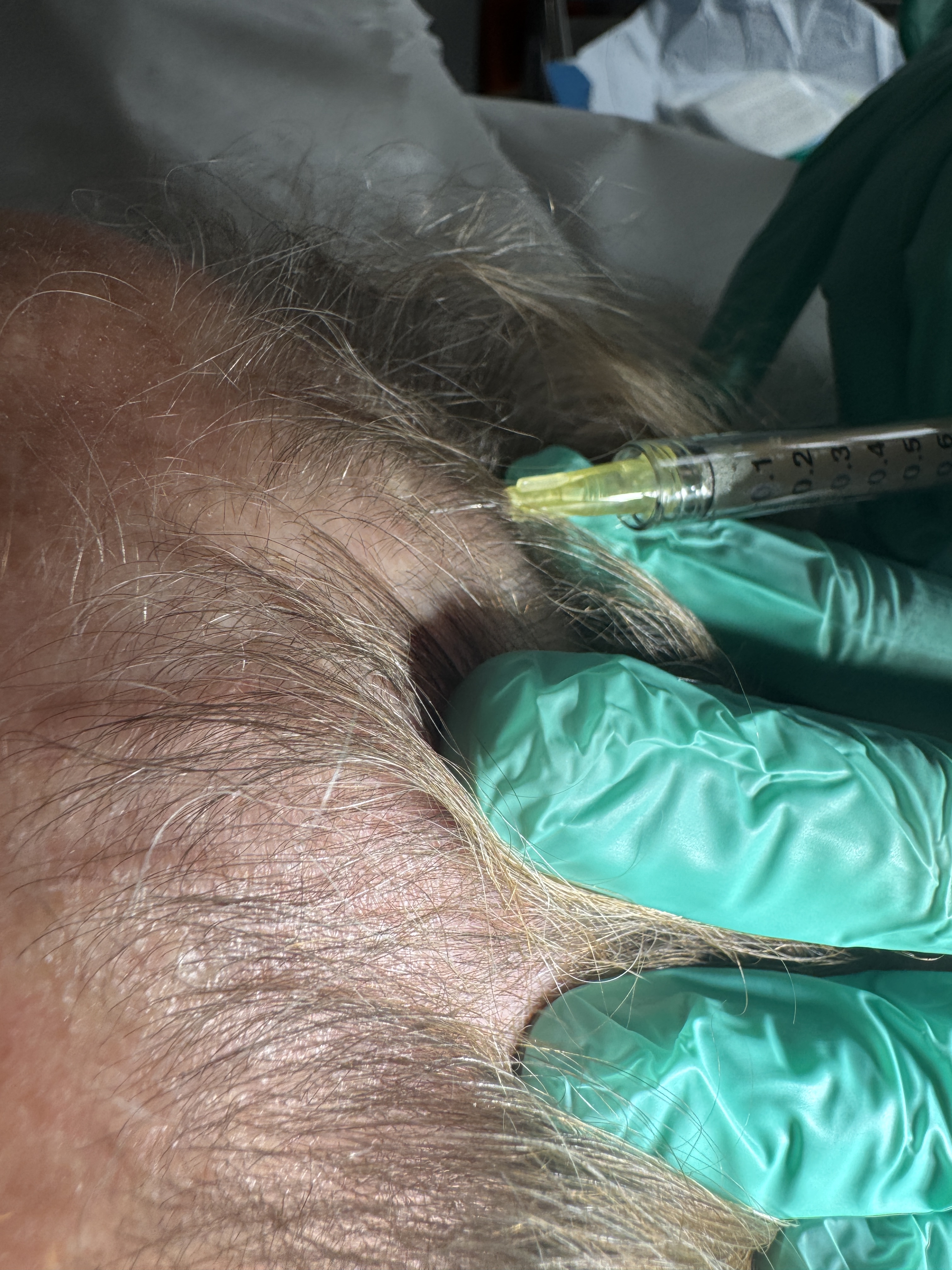 PRP treatment in progress